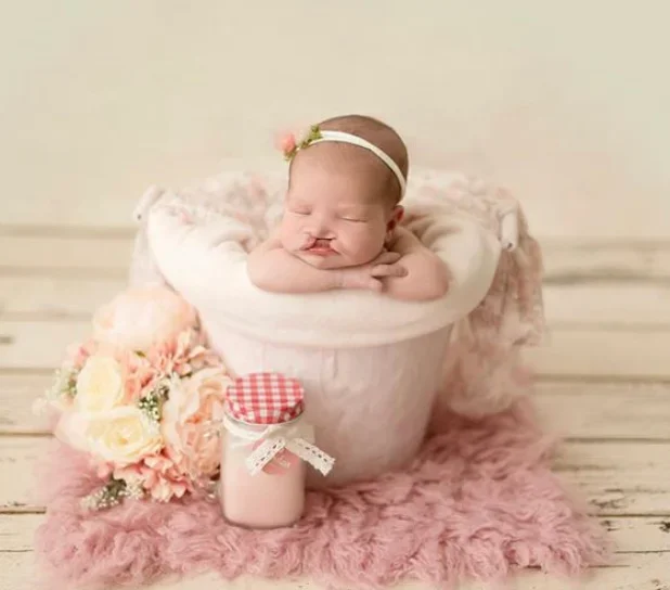 «Волчья пасть» и «заячья губа» что это такое