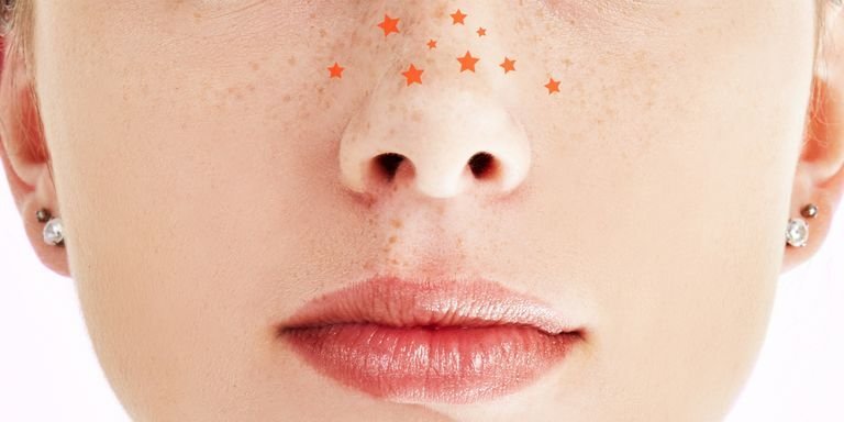 Черные точки на лице: угри и сальные нити. Как отличить, и почему не ...