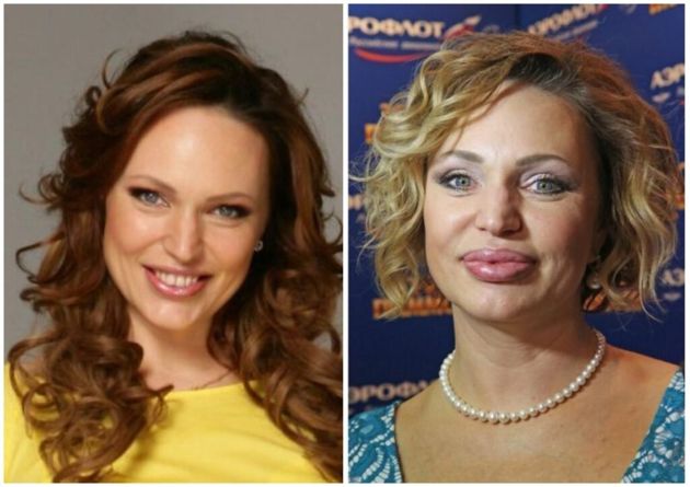 Алла довлатова до и после пластики фото Алла довлатова до и после пластики фото