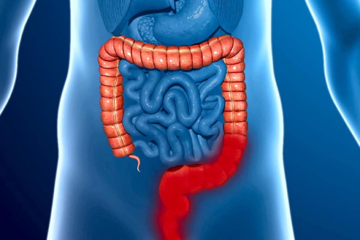 Воспаленный кишечник. Кишечник человека картинки.
