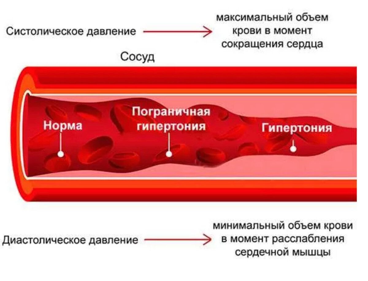И силы на исходе и кровоточат. Сосуды при высоком давлении. При высоком давлении сосуды расширяются или сужаются. Сужение сосудов и расширение ,давление. При высоком давлении сосуды сужаются.