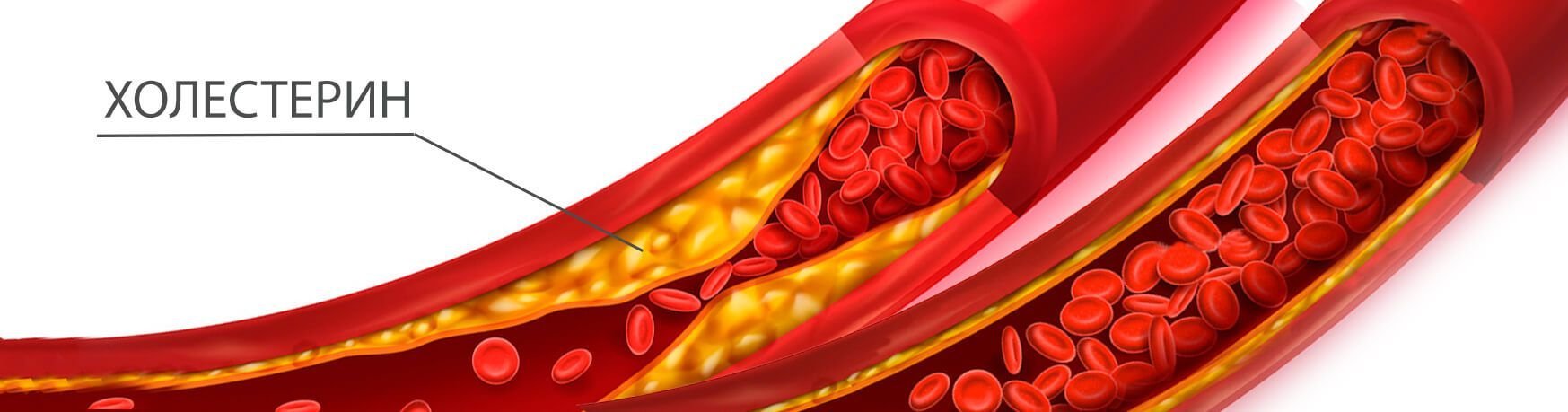 Атеросклероза показатели. Холестт. Холестерин. Высокий уровень холестерина. Борьба с холестерином.