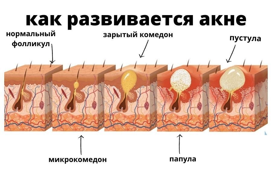 От тортов появляются прыщи