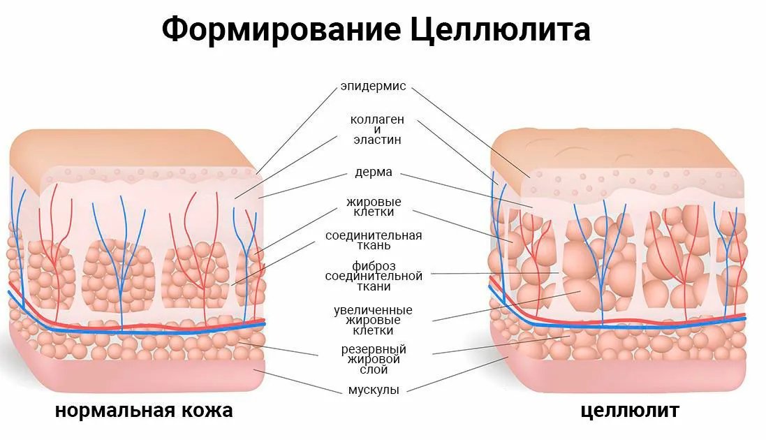 Слои жира. Целлюлит строение жировой ткани. Строение кожи целлюлит. Целлюлит стадии схема. Целлюлит структура кожи.