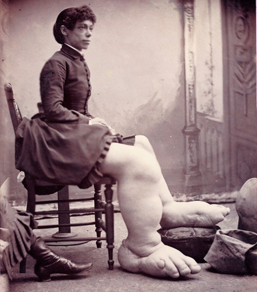 Фанни Миллс женщина с гигантскими ногами