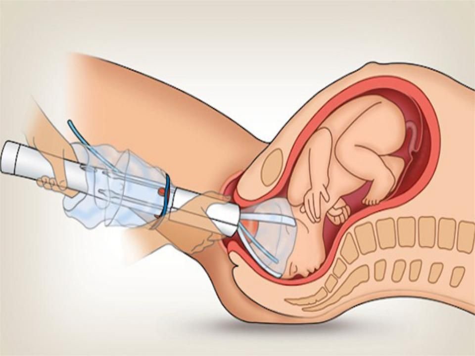 Медицина плода. Вакуумная экстракция плода. Вакуум экстрактор плода. Вакуум экстракция плода в родах.