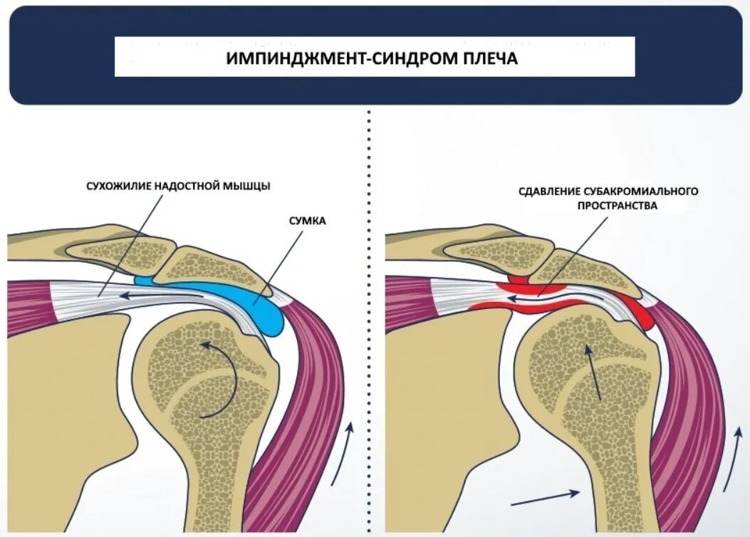 Импинджмент синдром плечевого сустава