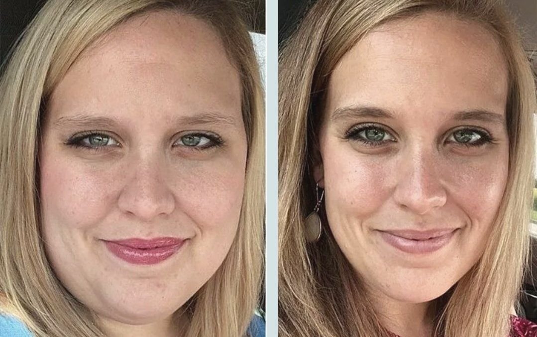 Собственный жир в лицо до и после фото