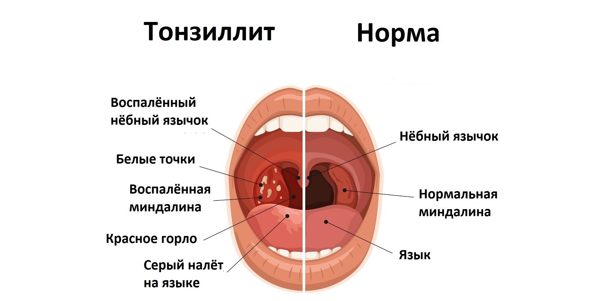 Что означает кровь во рту. Небные миндалины хронический тонзиллит. Клинические симптомы тонзиллит. Хронический тонзиллит вид гланд.