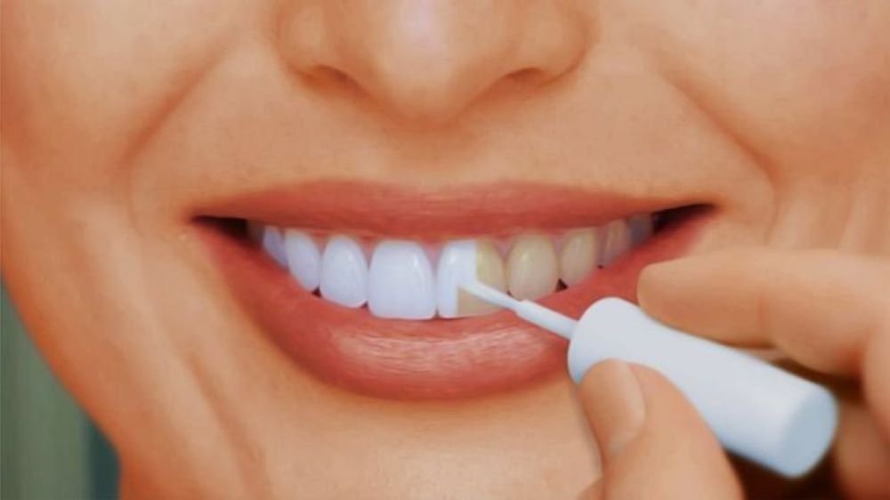 Как можно отбелить зубы в домашних условиях. Краска для зубов. Отбеливание зубной эмали. Краска для зубов белая.