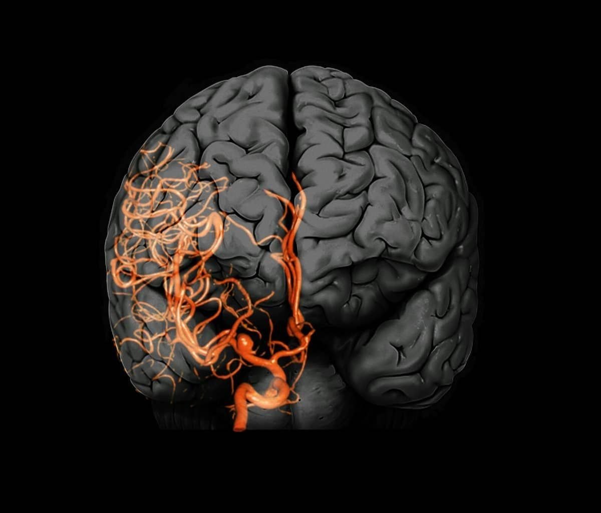 Видео сосудов головного мозга. Церебральные сосуды головного мозга что это.
