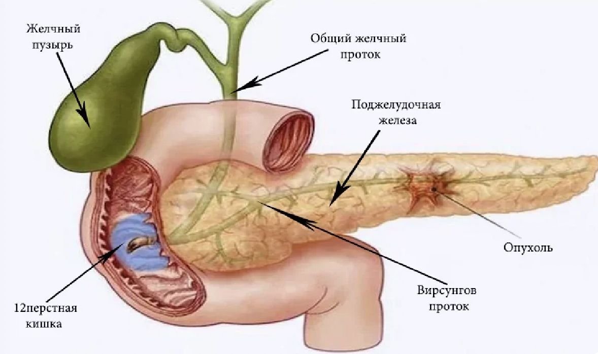 Рак под. Вирсунгов проток анатомия. Кистофиброз поджелудочной железы. Вирсунгов проток поджелудочной железы. Вирсунгов проток анатомия поджелудочной железы.