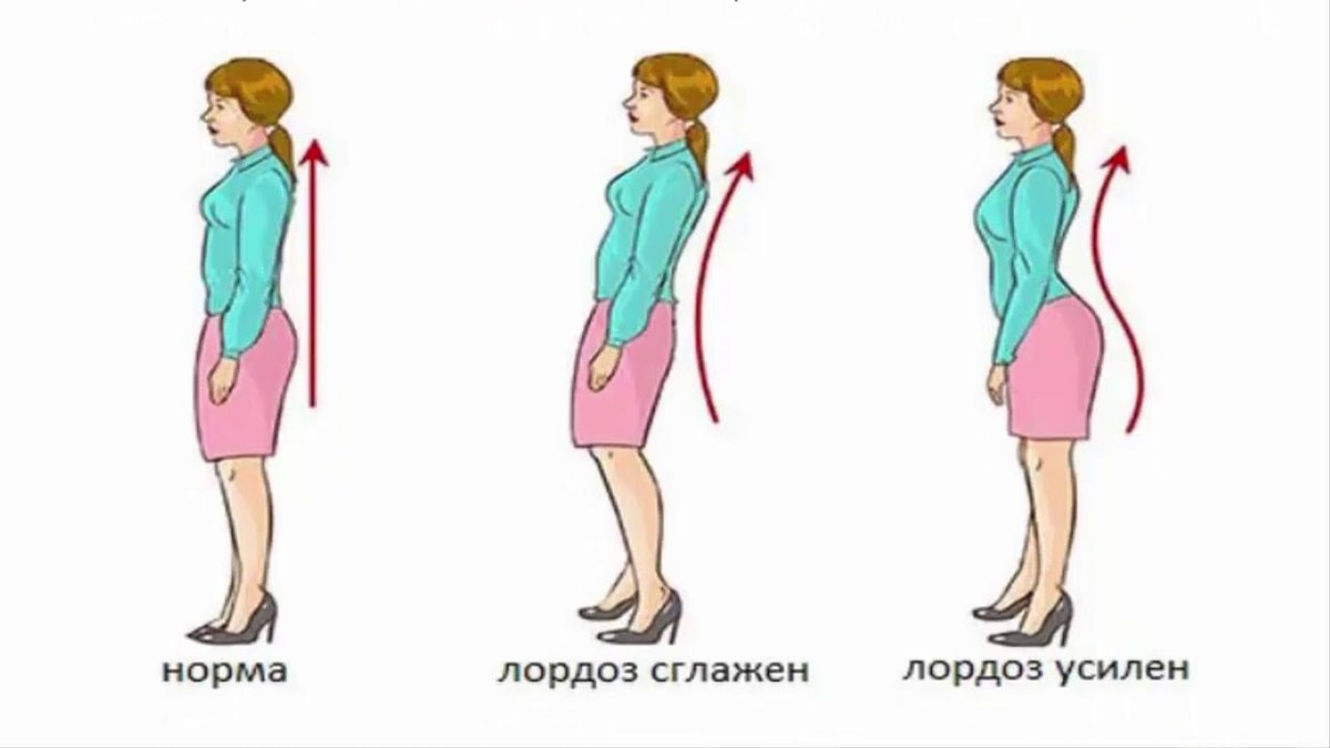 лордоз поясничного отдела позвоночника. выпрямленный лордоз поясничного отдела. лордоз поясничного отдела позвоночника сглажен. шейный лордоз кифоз. лордоз поясничного отдела позвоночника сглажен.