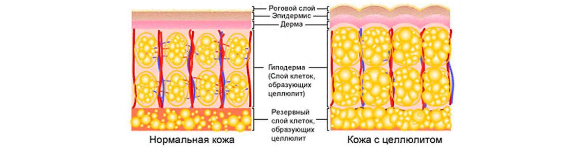 Стадии целлюлита в картинках 4