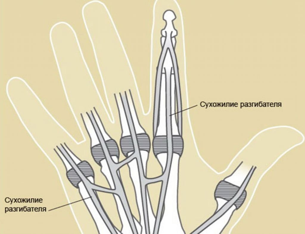 Тендинит сухожилия пальца