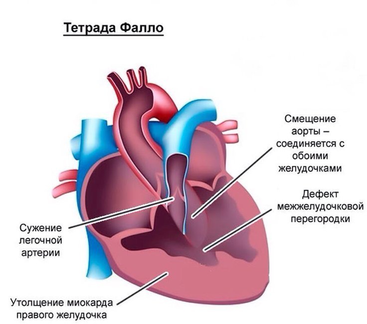 Тетрада фалло клиническая картина