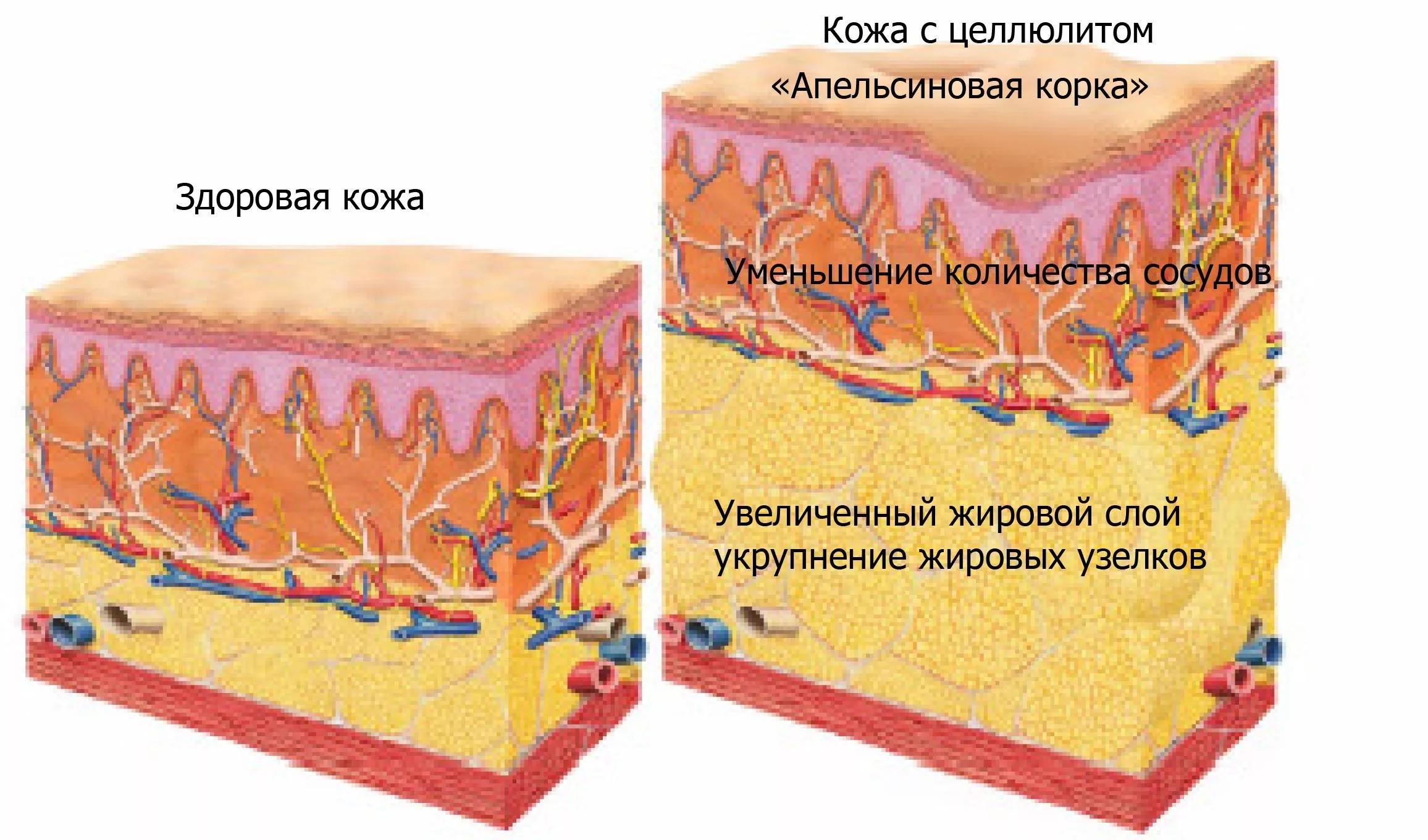 Жировая кожа. Подкожная жировая клетчатка ткань. Целлюлит строение жировой ткани. Гиподерма кожи человека. Слой кожи и подкожно-жировой.