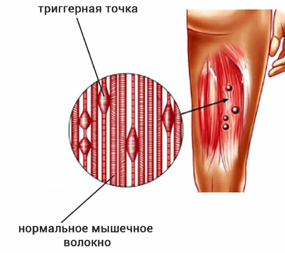 Триггерная точка в мышцах