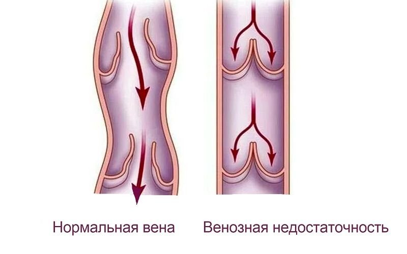 Усиление венозного рисунка на теле причины