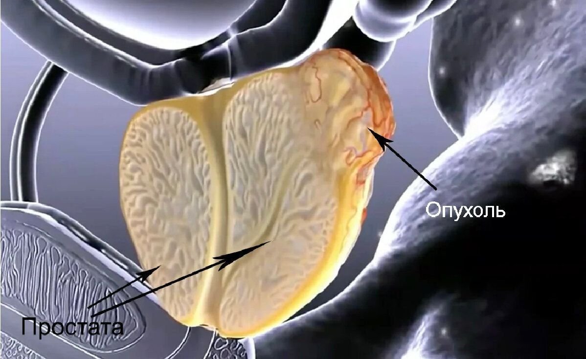 Простата развивается. Предстательная железа 3д. Мультифокал биопсия предстательной железы.