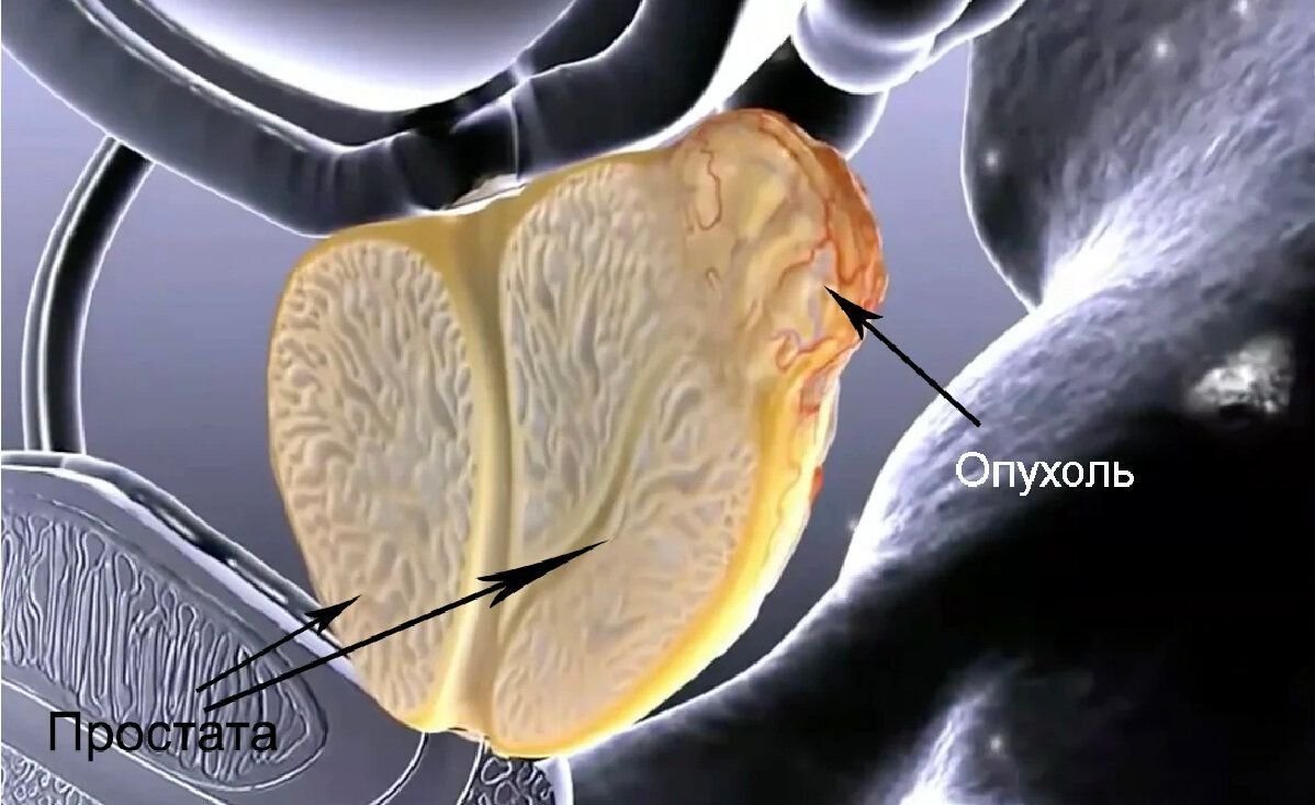 Простата что это фото