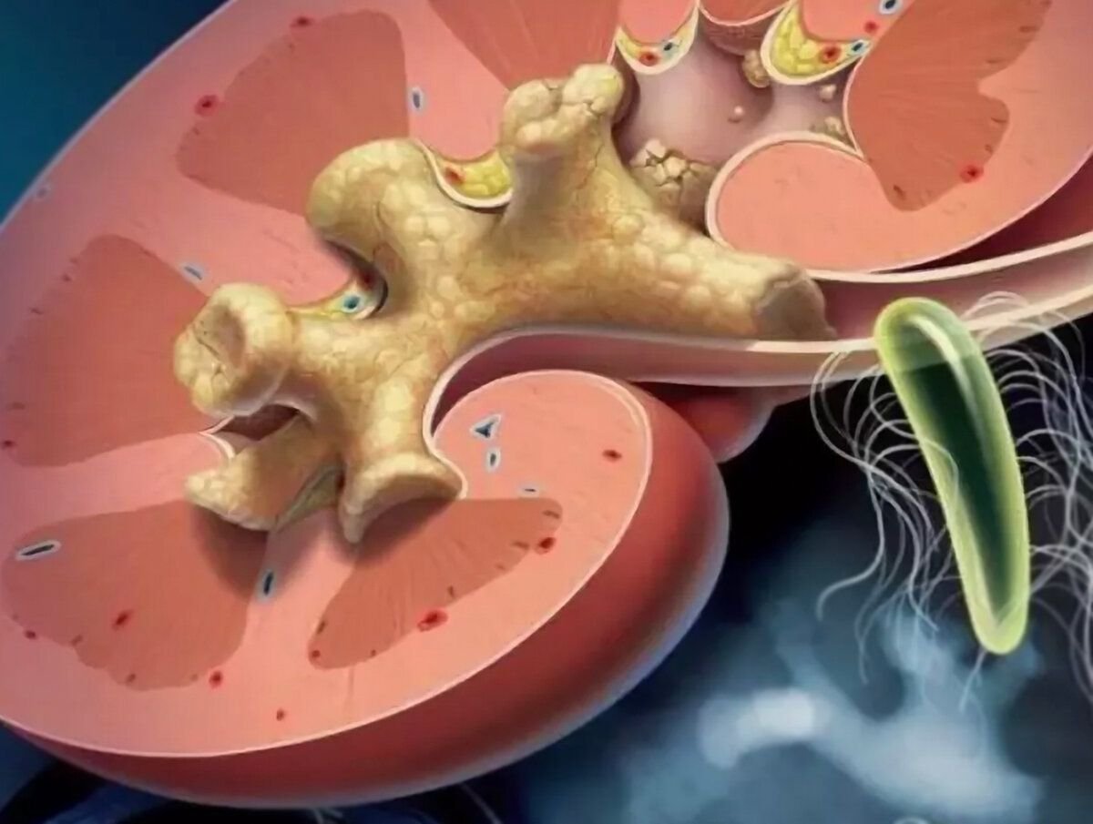 Камни в почках. Мочекаменная болезнь коралловидные камни. Коралловидный нефролитиаз. Мочекаменная болезнь коралловидный нефролитиаз. Коралловый нефролитиаз.
