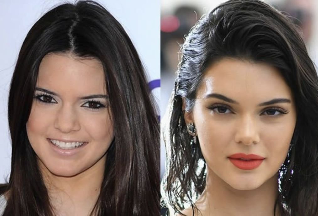 Меньше сейчас. Kendall Jenner Plastic Surgery. Kendall Jenner before Surgery. Kendall Jenner before Plastic Surgery. Kendall Jenner before and after Surgery.