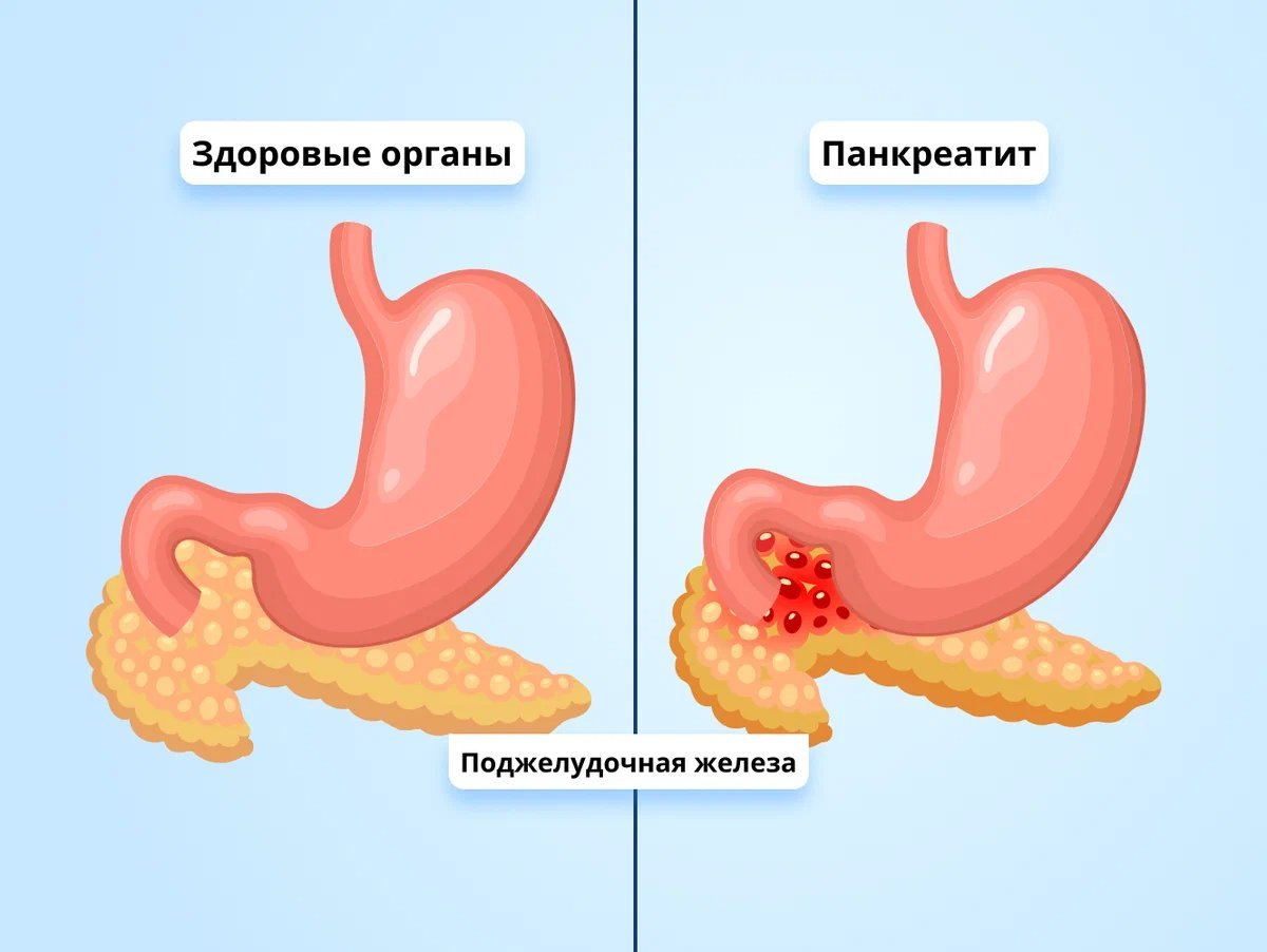 Воспаление поджелудочной