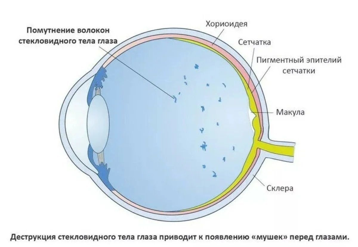 Стекловидное тело глаза. Помутнение волокон стекловидного тела глаза. Фибропластический процесс стекловидных тел.. Как выглядит стекловидное тело глаза. Де трукция стекловидного тела.