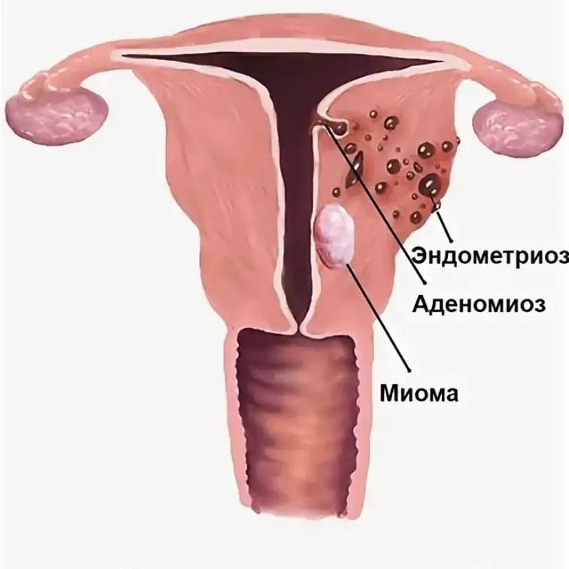 Миома и эндометриоз. Аденомиоз и эндометриоз. Миома матки эндометриоз матки. Аденомиоз и эндометриоз матки.