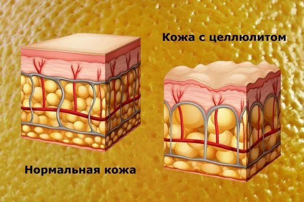 Жировая кожа. Целлюлит жировые клетки. Целлюлит подкожный жир. Строение кожи целлюлит.