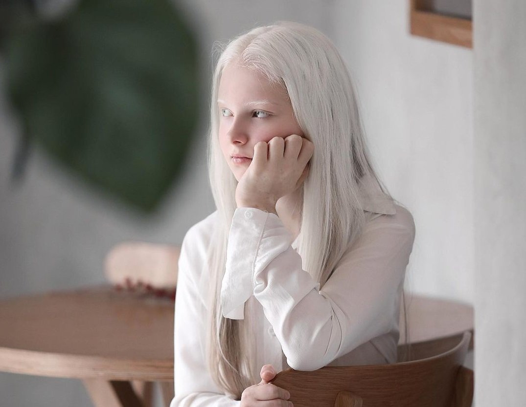 Амина Эпендиева альбинос