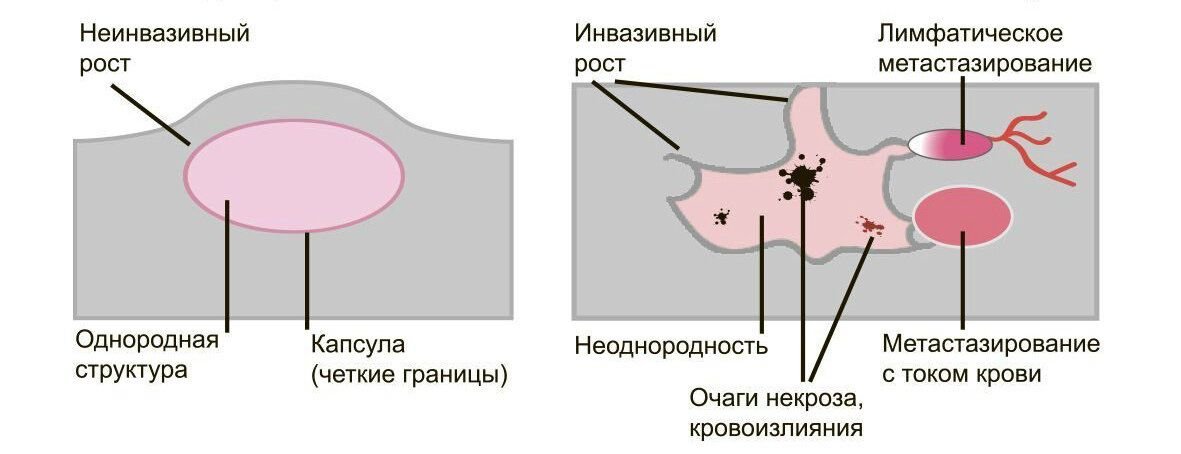 Взрослая опухоль это что