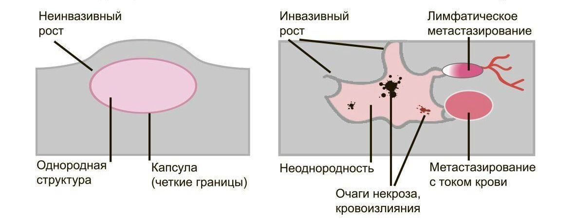 Чем отличается рак. Разница доброкачественной и злокачественной опухоли. Злокачественная опухоль и доброкачественная отличие. Разница между доброкачественной и злокачественной опухолью. Как отличить раковую опухоль от доброкачественной.