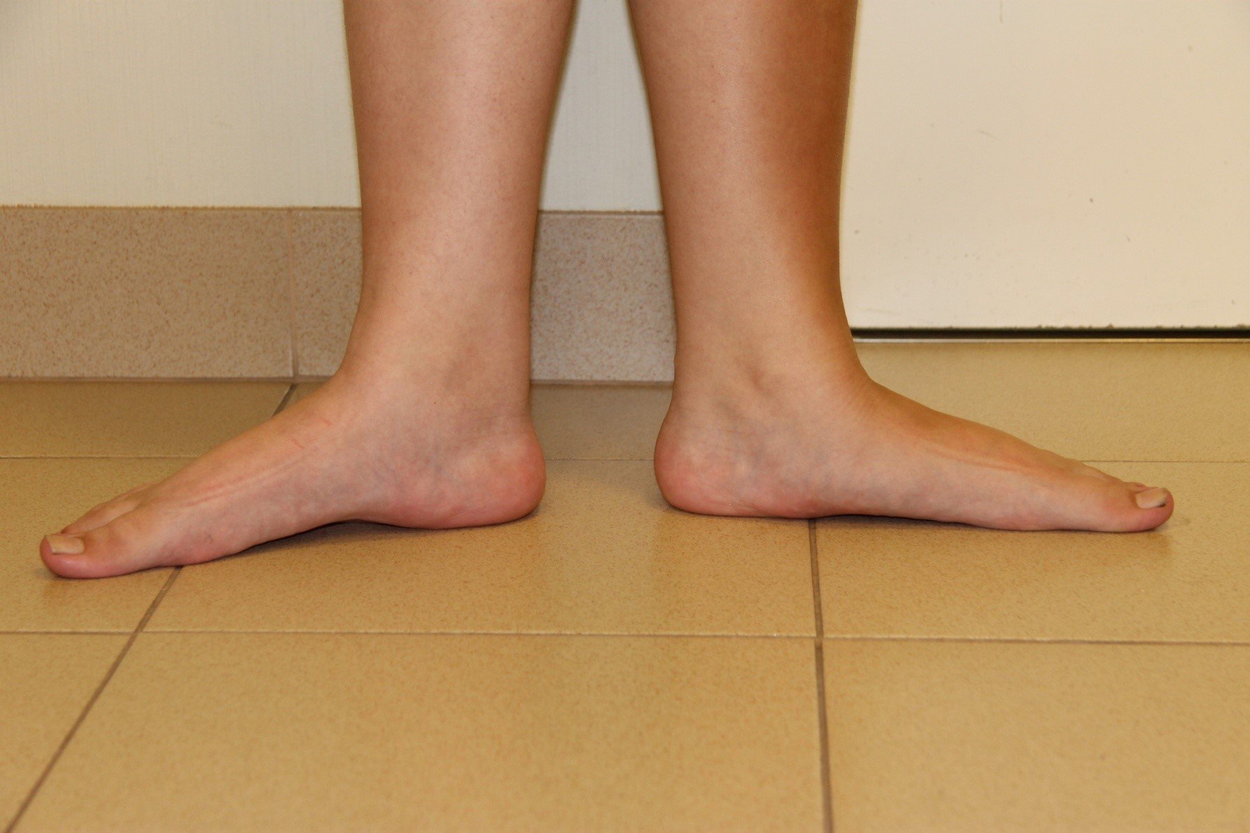 Как выглядит стопа при плоскостопии 3 степени фото ног
