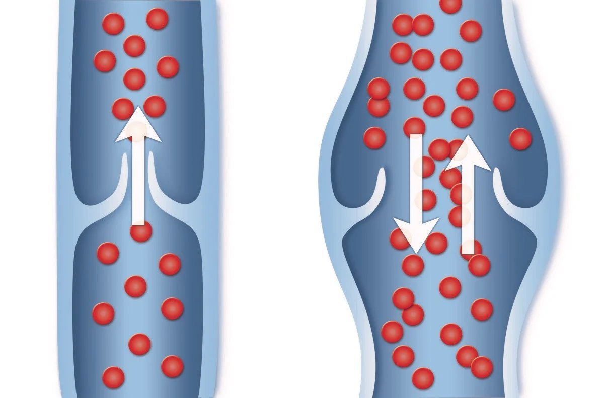 Клапан вены. Венозные клапаны варикоз. Клапаны в венах нижних конечностей.