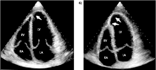 Эхо левого желудочка