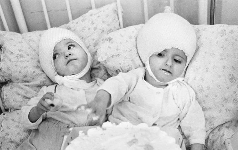 бен карсон и сиамские близнецы. разнояйцевые двойняшки. двойники 1987 года. близнецы 1987 года. миннесота 1987.