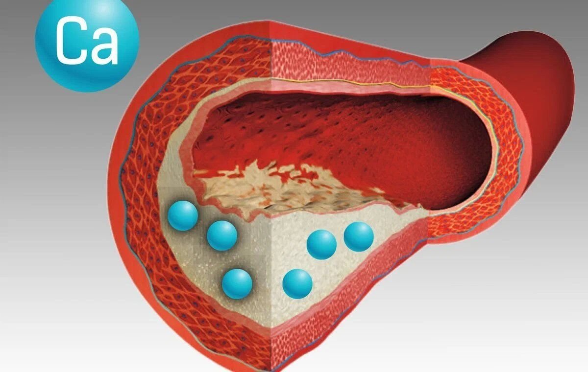 Атеросклеротическая сердца. Атеросклероз кальциноз. Кальцификация в бляшках атеросклероза. Атерокальциноз стенки артерий это.