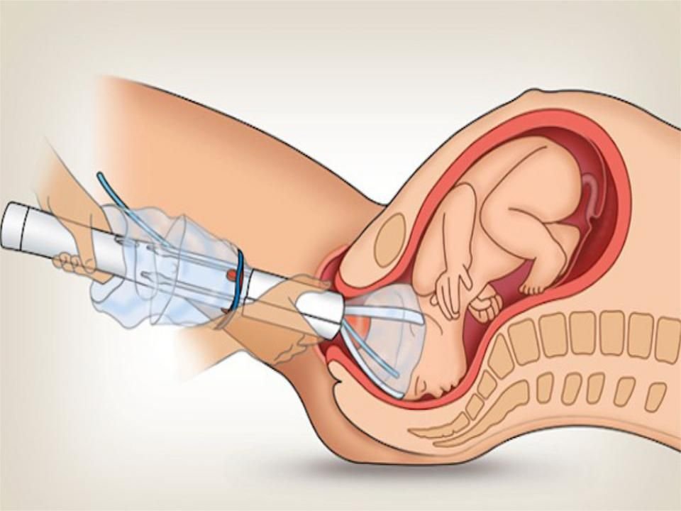 прерывание беременности вакуум-аспирацией. вакуум-экскохлеация полости матки.