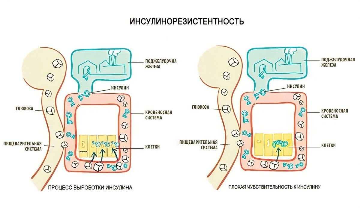 Инсулинорезистентность в картинках