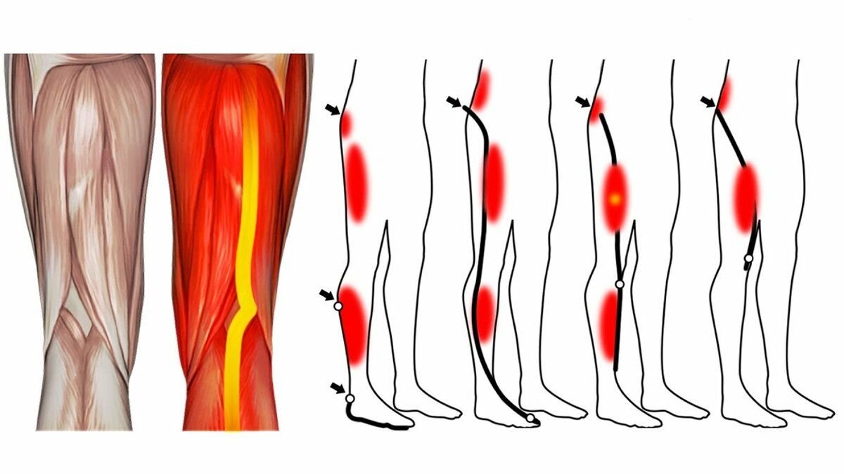 Болят мышцы ног причины. Боли от бедра до колена.
