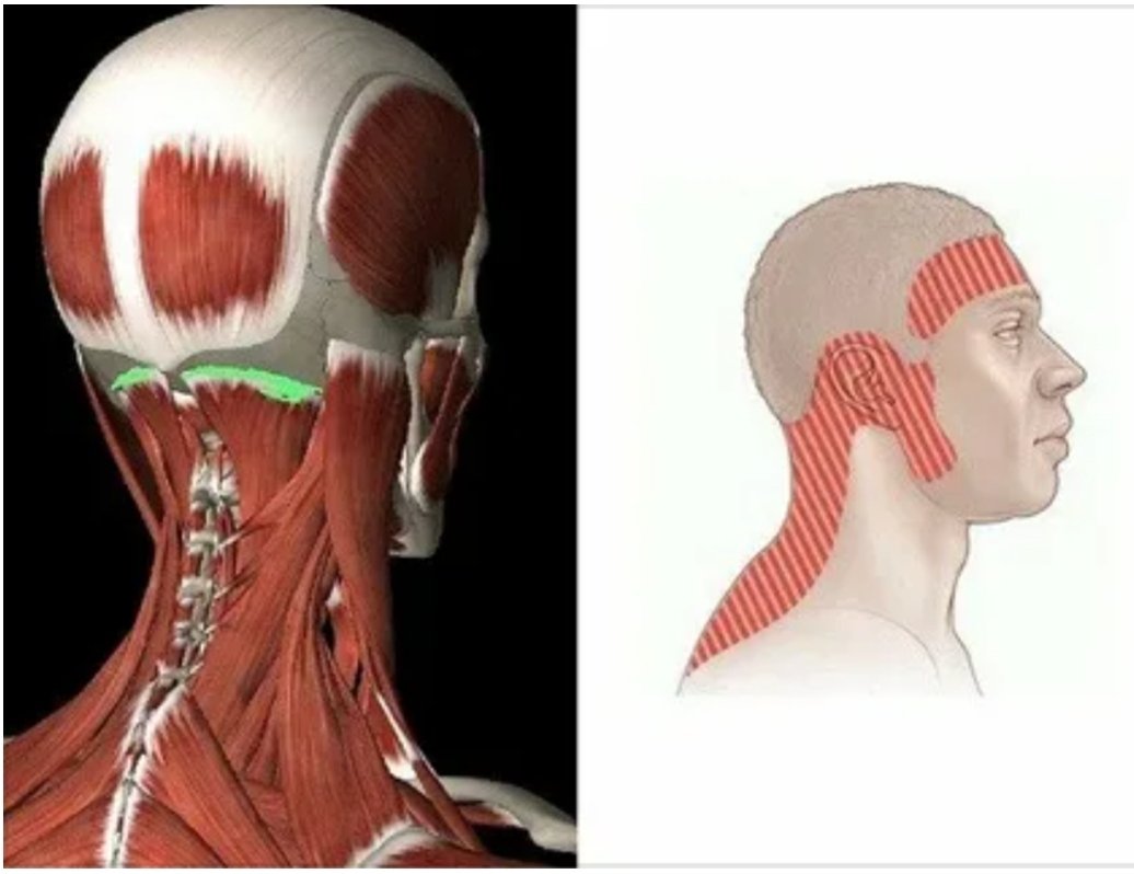 Боль в шее и голове. Мышцы головы затылок. Мышцы под затылком.