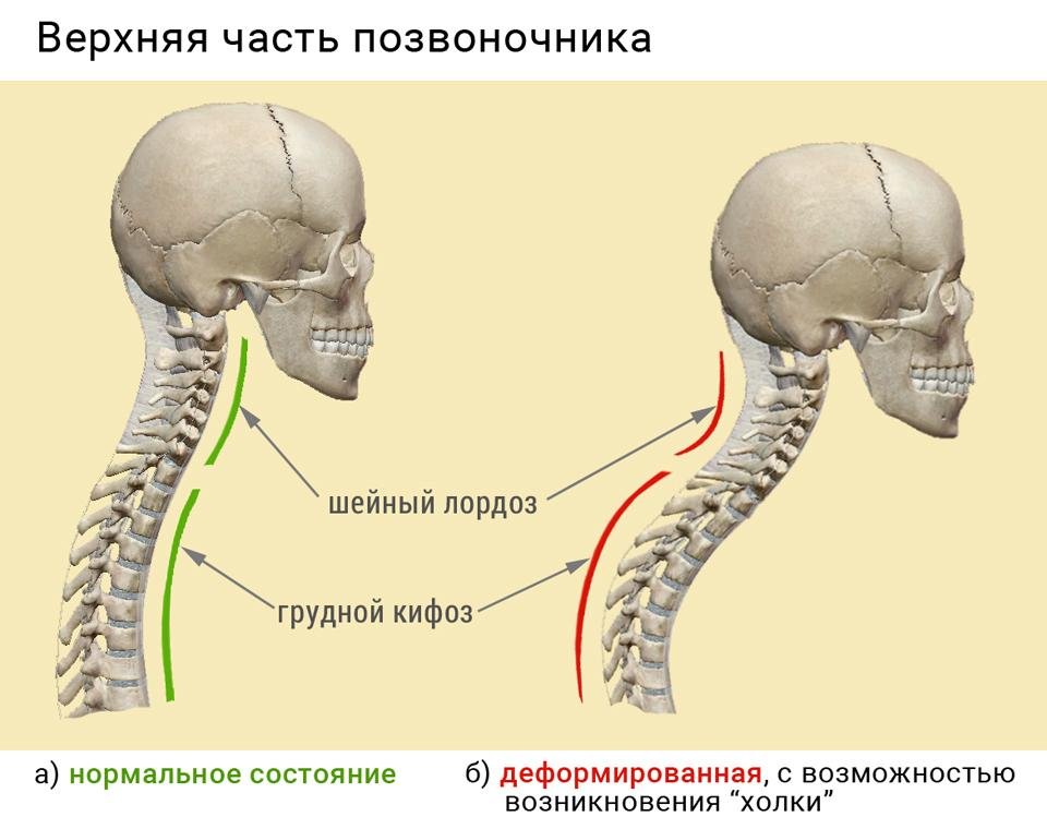 Правильная шея. Лордоз шейного отдела позвоночника. Лордоз и кифоз шейного отдела. Выпрямленный лордоз шейного отдела позвоночника. Физиологический лордоз шейного отдела позвоночника.