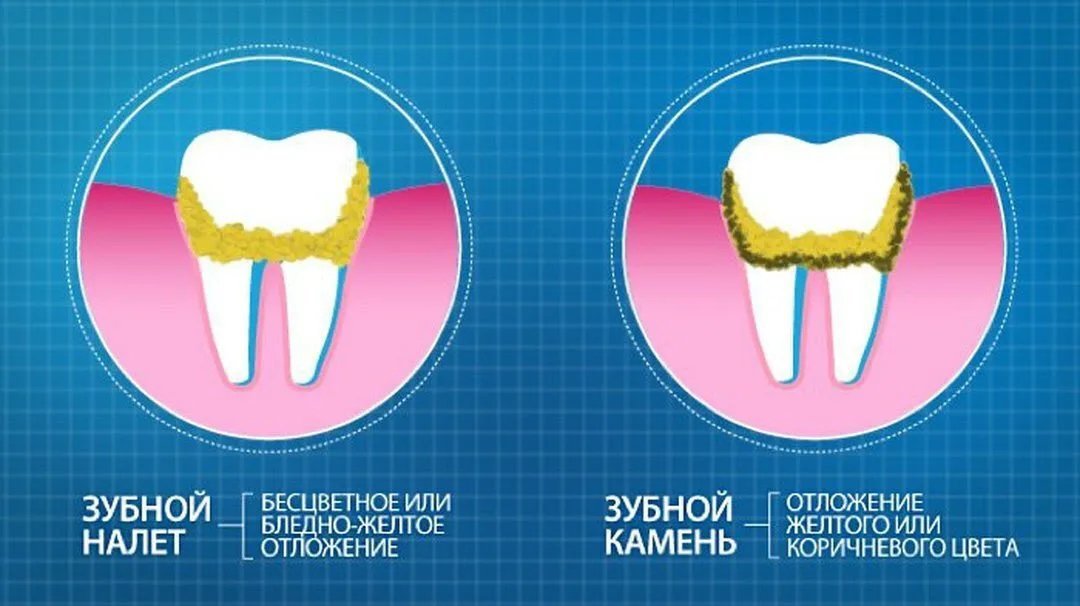 Почему зубы отличаются. Зубной какамекакамень.