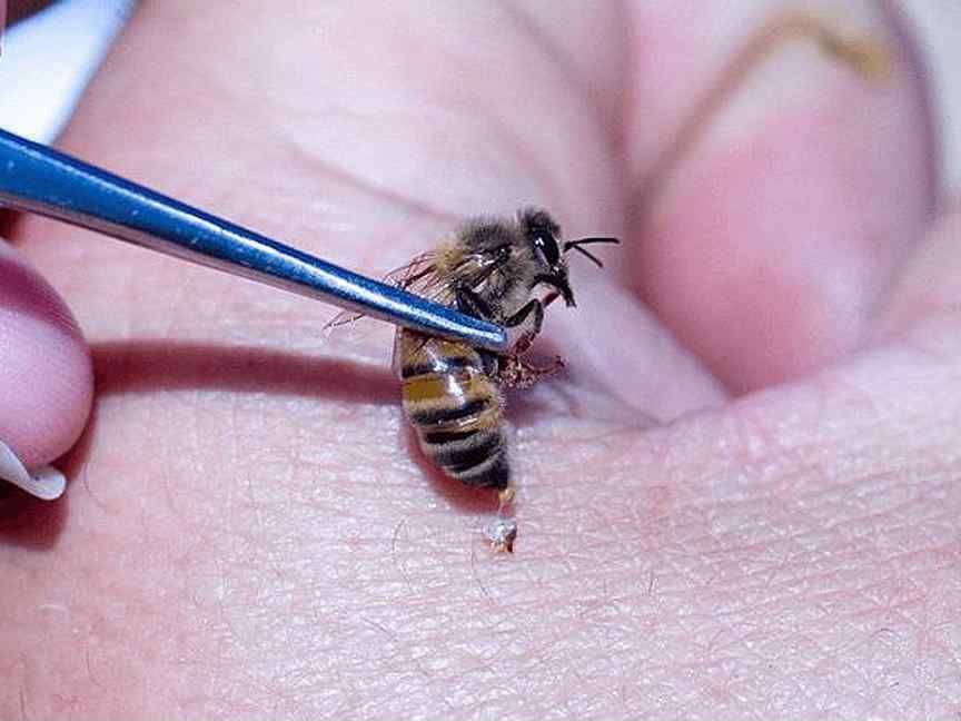 Снять укус пчелы