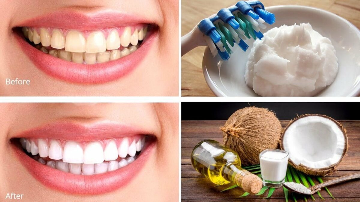 Можно чистить зубы в рамадан зубной пастой. Отбеливание зубов. Кокосовое масло для отбеливания зубов. Отбеливание зубов кокосовым маслом. Отбеливание для зубов с кокосом.