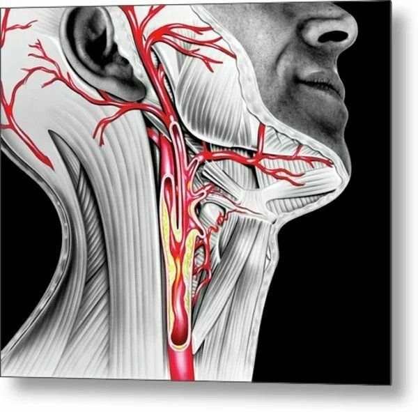 Бляшки в сонной артерии шейного отдела фото