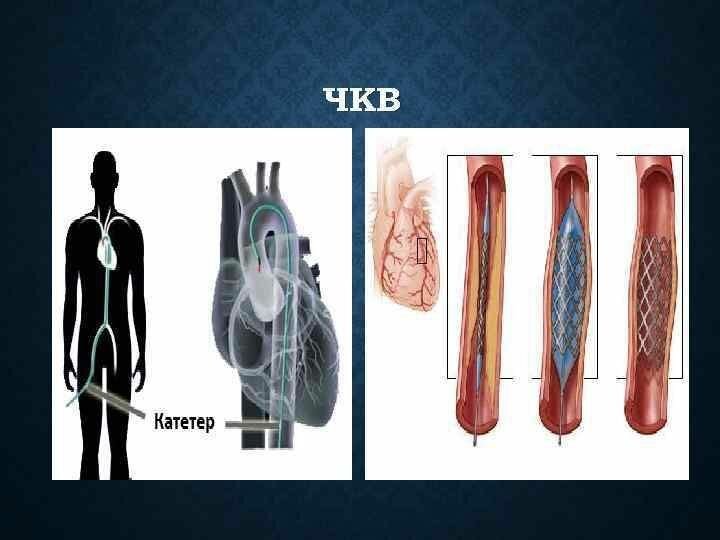 Чкв в кардиологии. ЧКВ баллонная ангиопластика. Первичное чрескожное коронарное вмешательство.