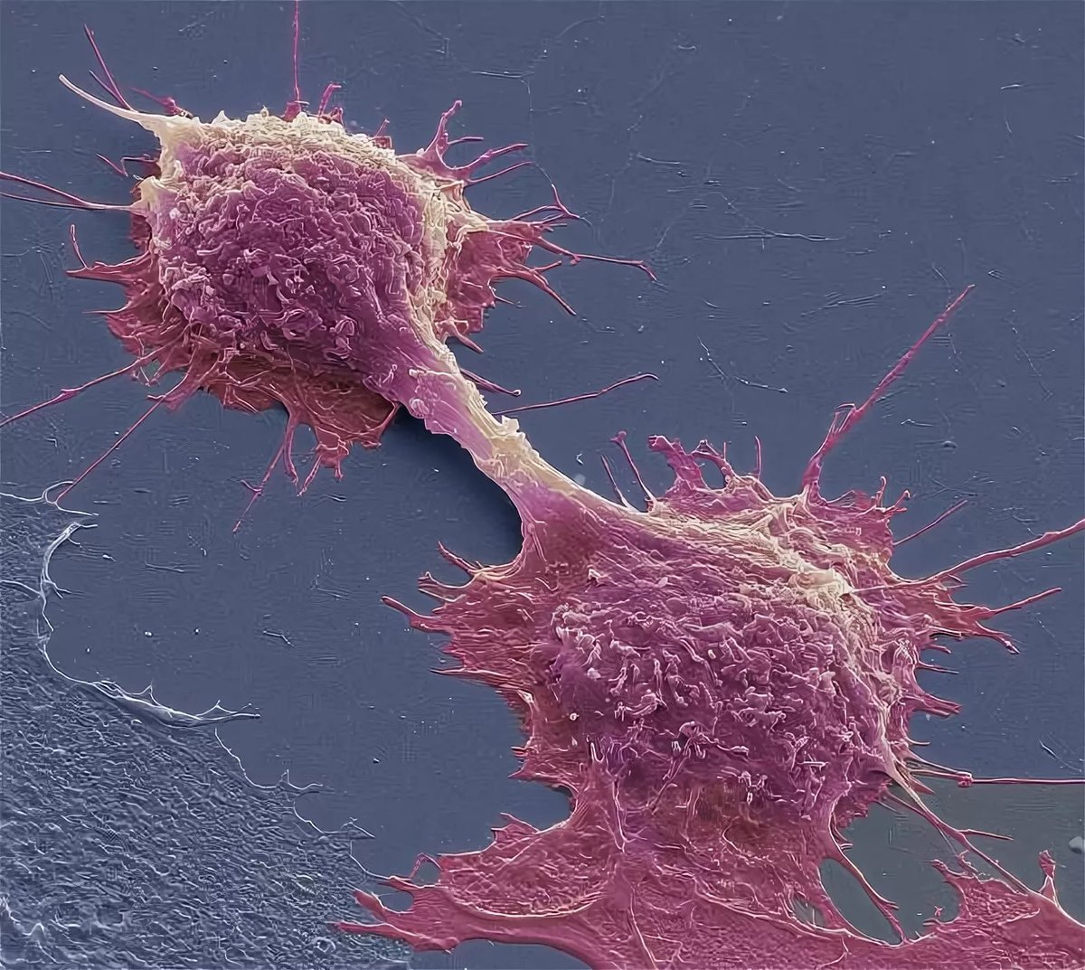 Вызывают злокачественные образования. Опухолевые клетки. Раковые клетки под микроскопом. Раковые клетки под микросокп.